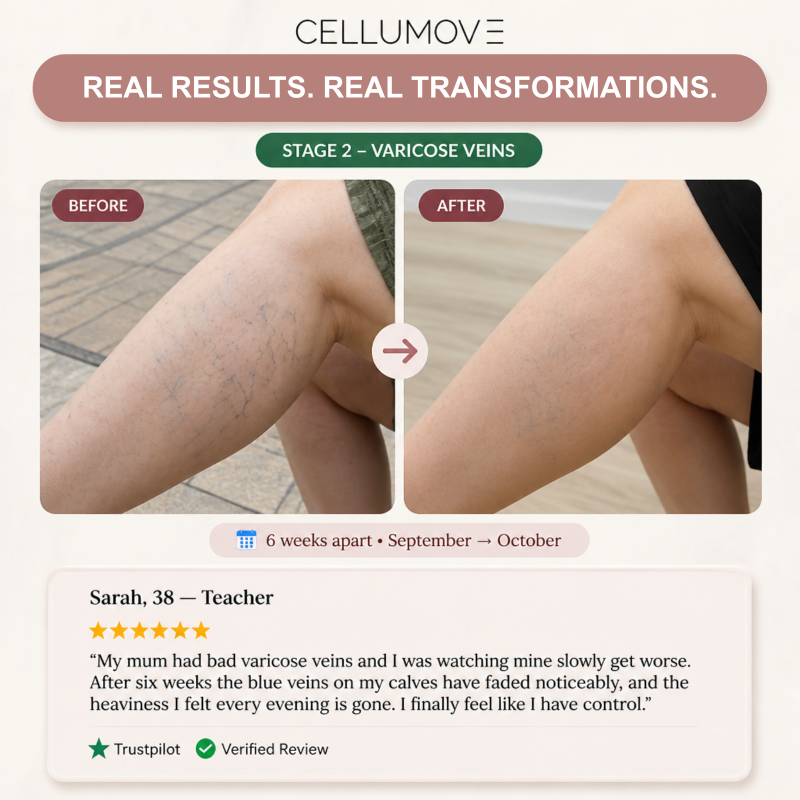 Before and after photos showing the reduction of varicose veins on a woman's legs over six weeks.