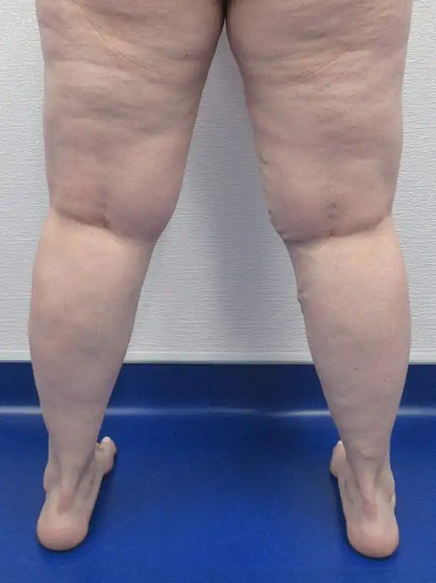Posterior view of a person's legs showing significant swelling and dimpling from the thighs to the calves.