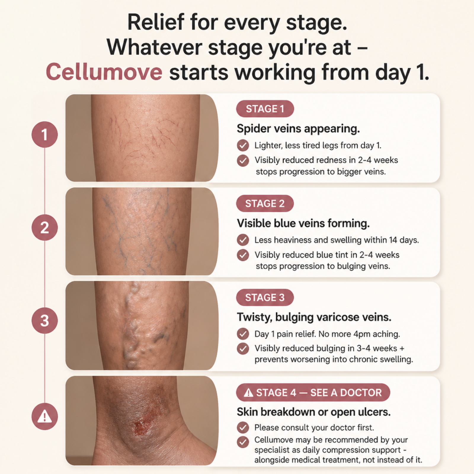 Infographic showing four stages of vein problems on legs, with descriptions for spider veins, varicose veins, and ulcers.