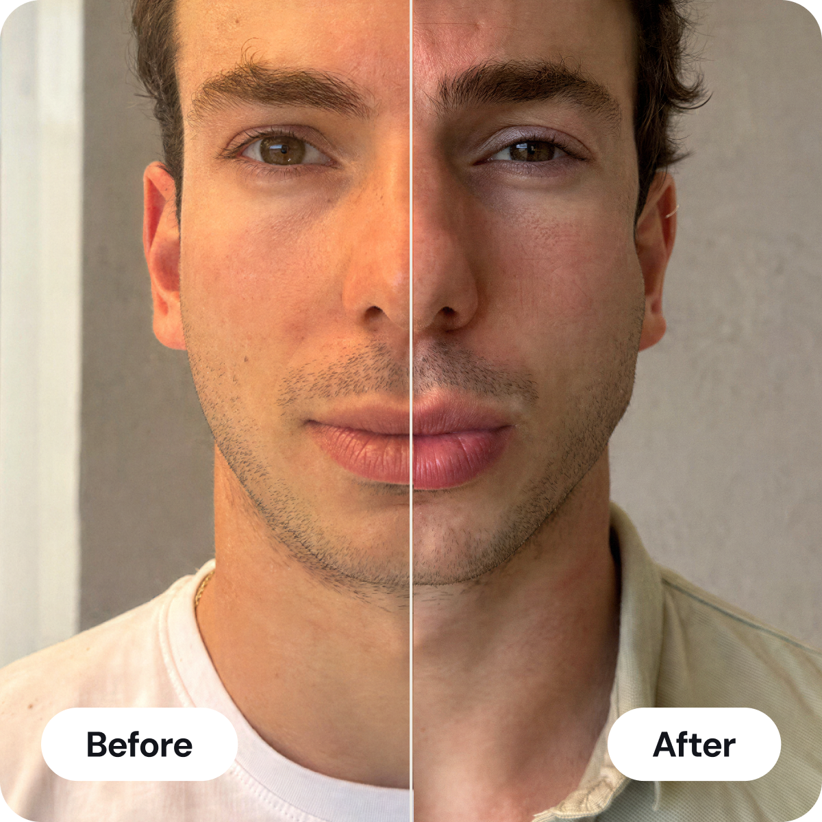 Before and after comparison of a man's jawline definition
