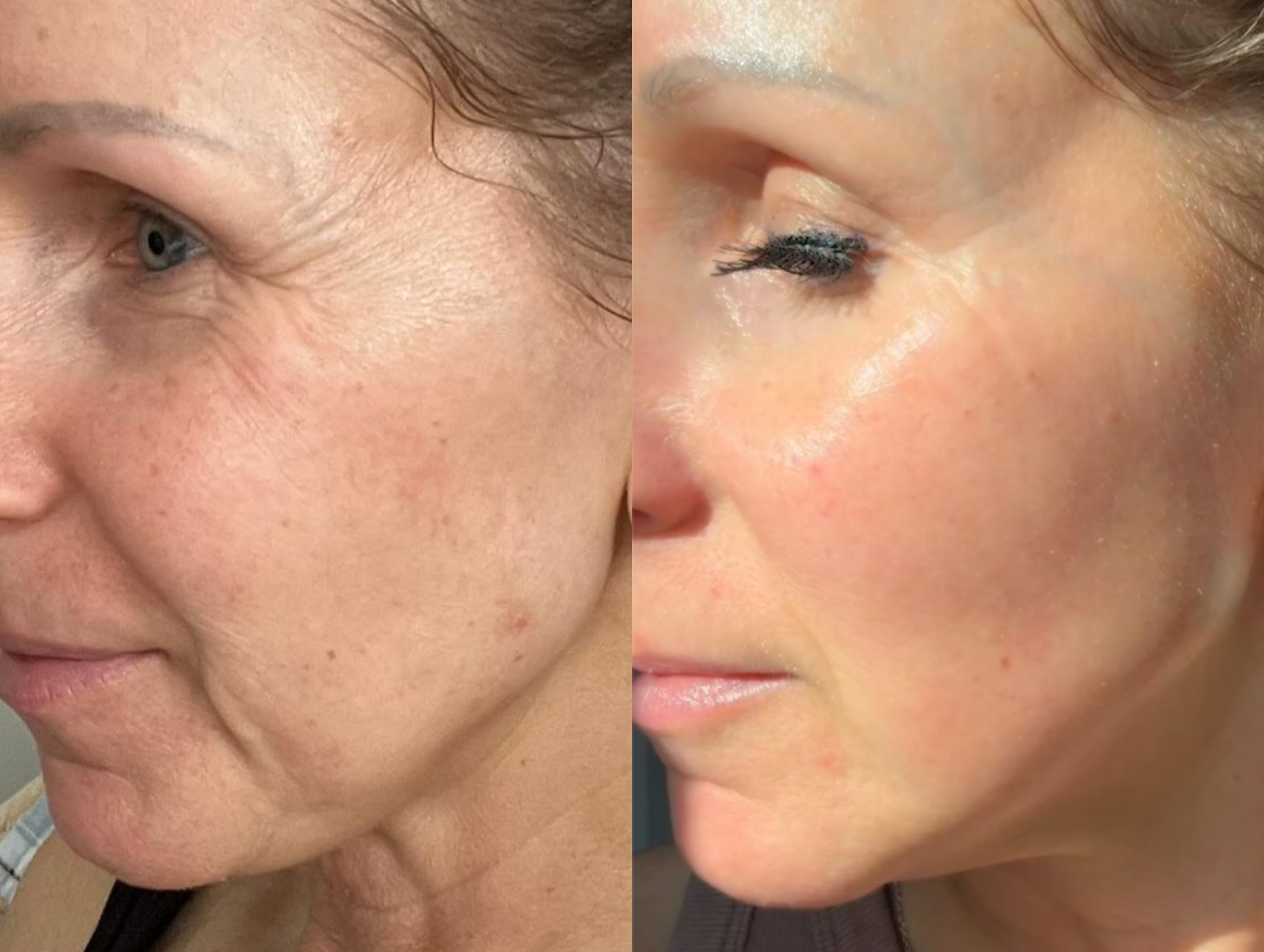 A side-by-side, before-and-after comparison of a woman's face, showing a reduction in wrinkles and improved skin texture.