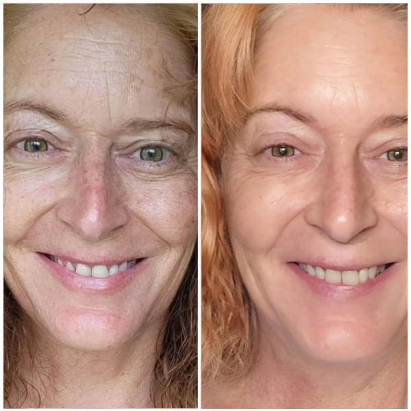 A before-and-after split image showing a woman's face, with a reduction in visible wrinkles and redness.