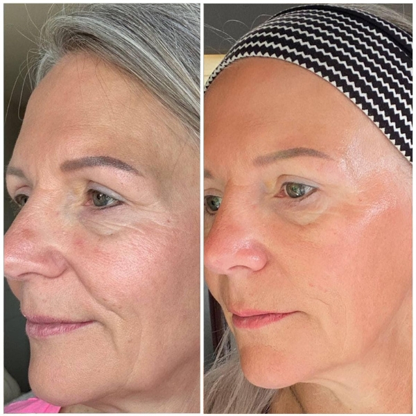 A side-by-side before and after image of a woman's face, showing a reduction in visible wrinkles.