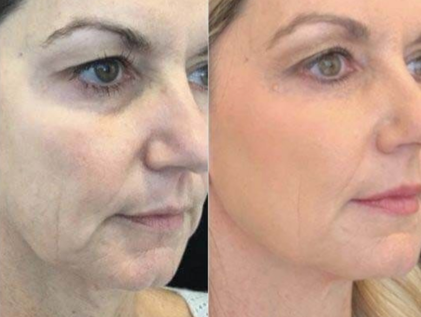 A before-and-after comparison of a woman's face, showing a reduction in wrinkles and sagging skin on the jawline.