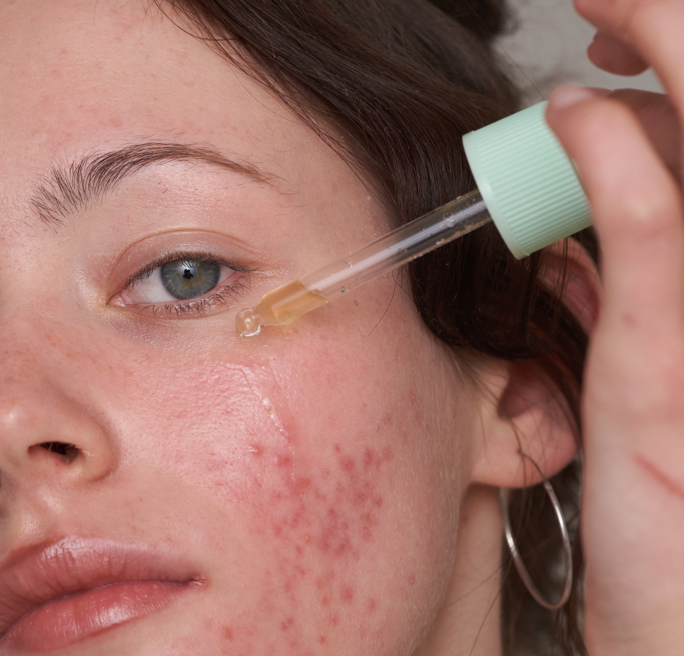 Close-up of a person applying serum with a dropper to their cheek.