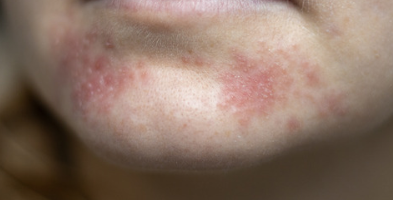 A close-up of a person's chin with red, inflamed skin and small bumps.
