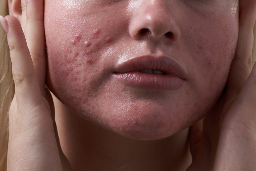A close-up of a woman's face showing redness and acne breakouts on her cheeks and chin.