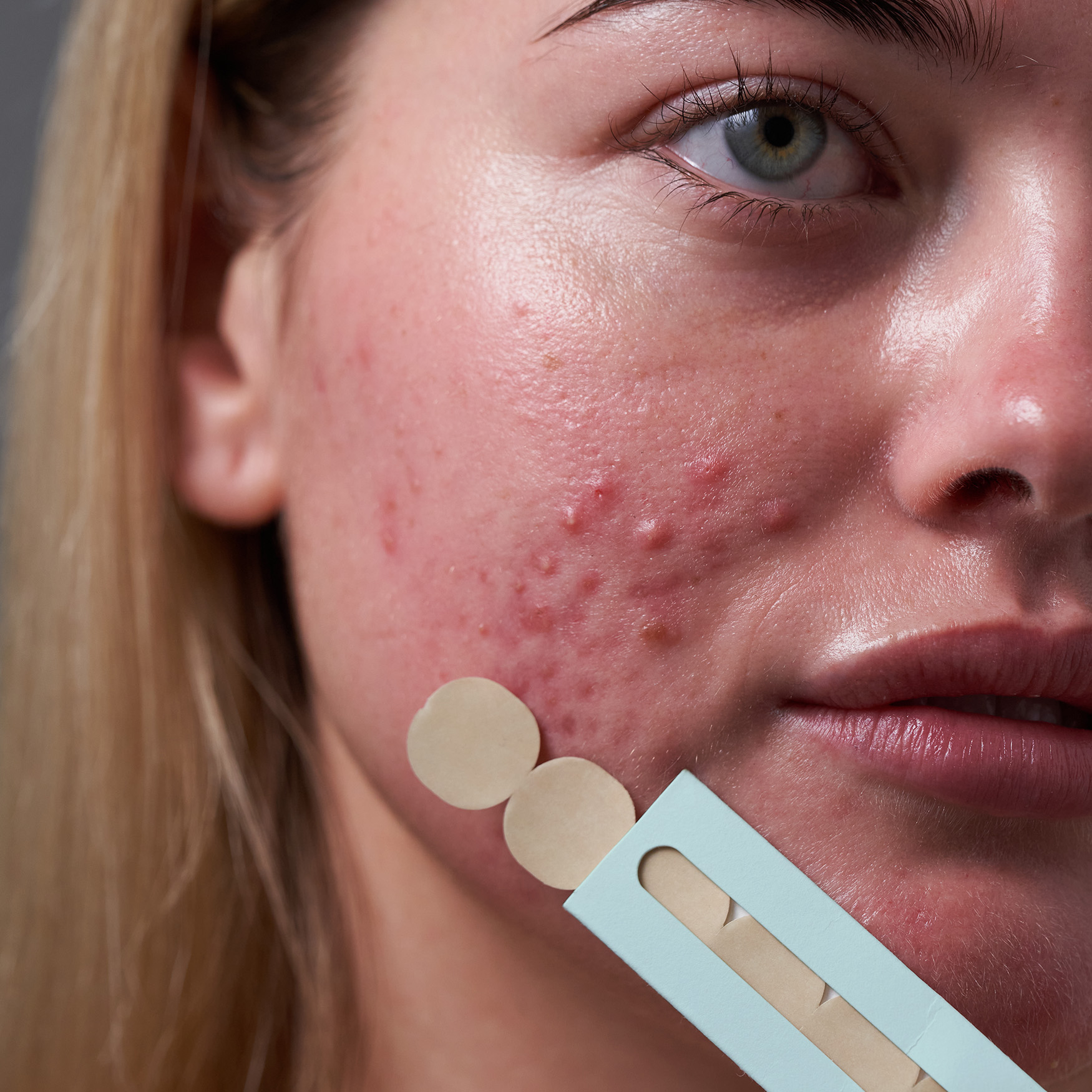 Close-up of a person's face with acne and acne patches.