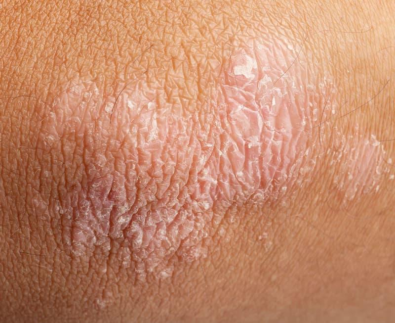 Eczema flare up skin close up