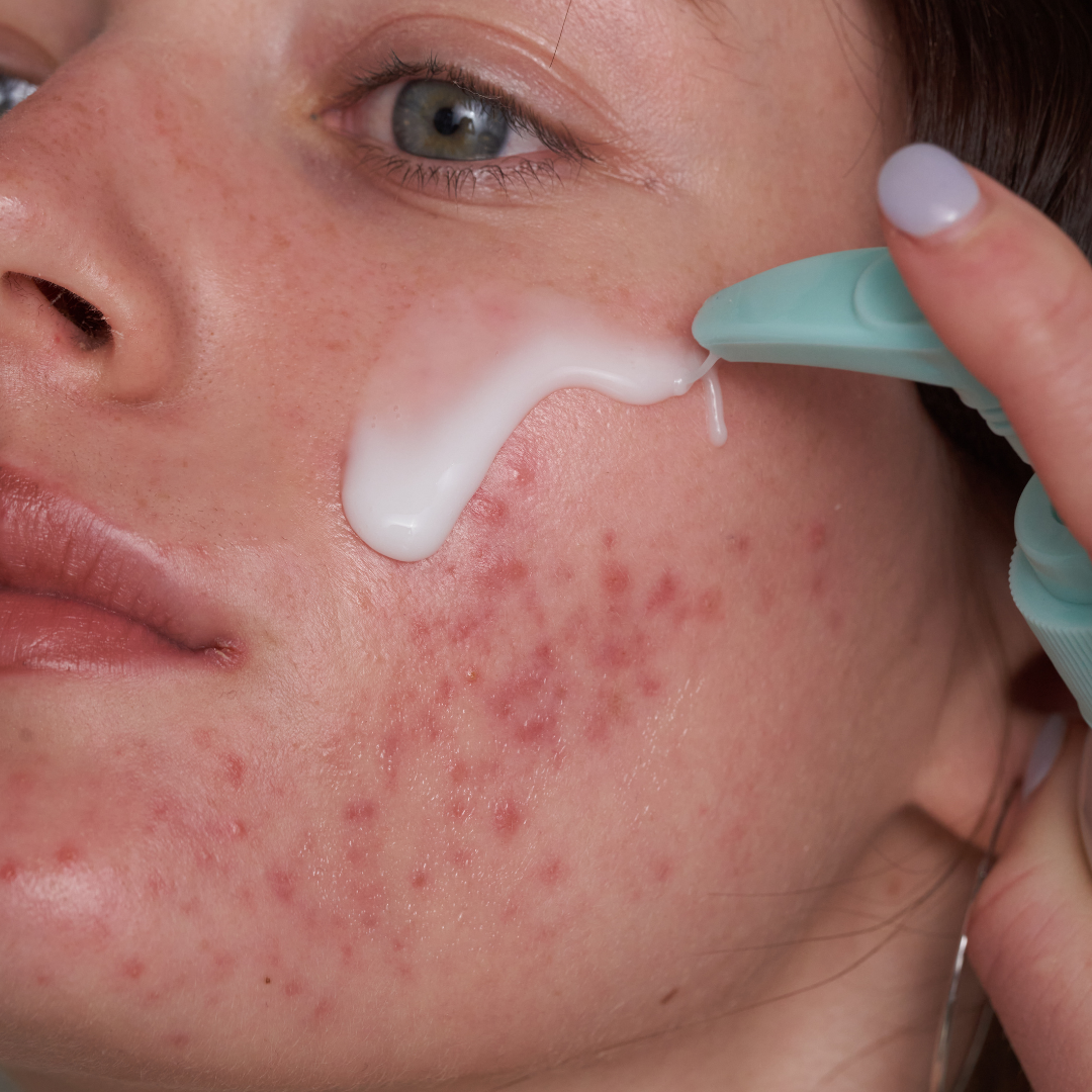Close-up of a person applying cream on acne-prone skin with a green tool.