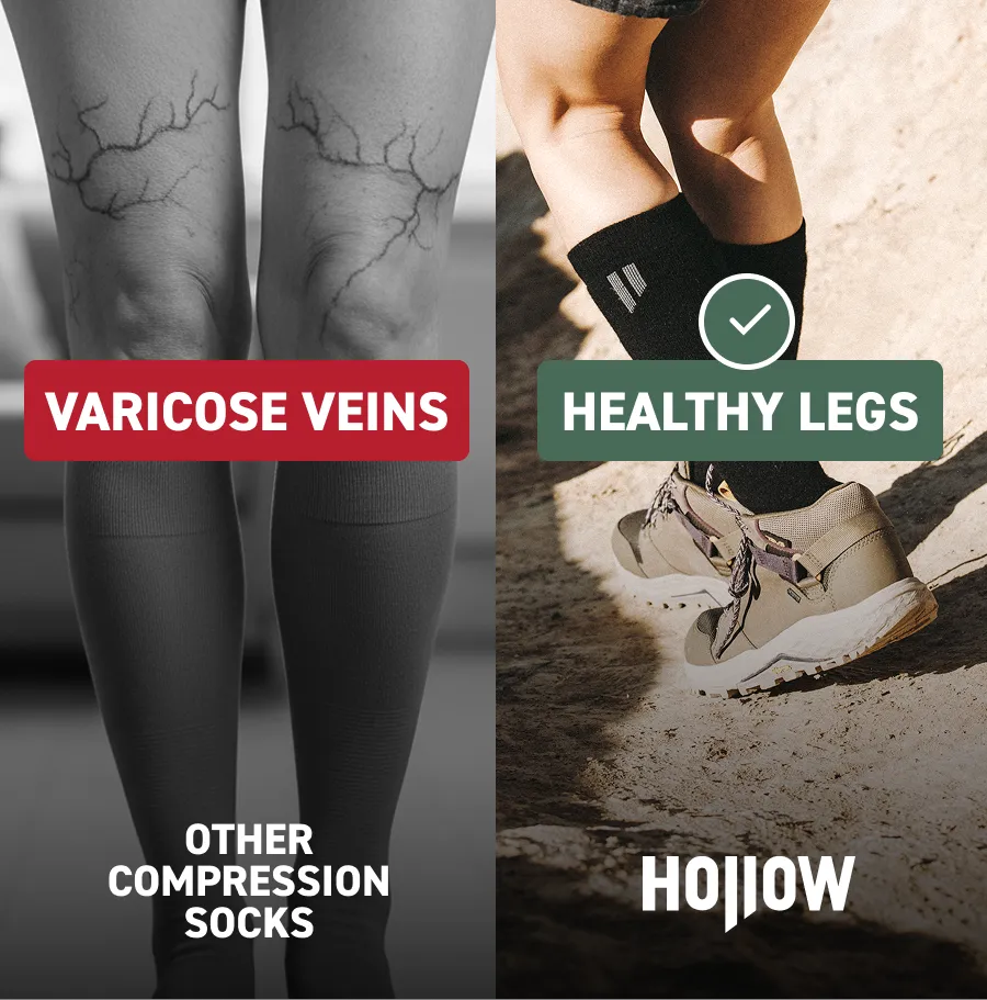 Comparison of legs with varicose veins and healthy legs wearing compression socks.