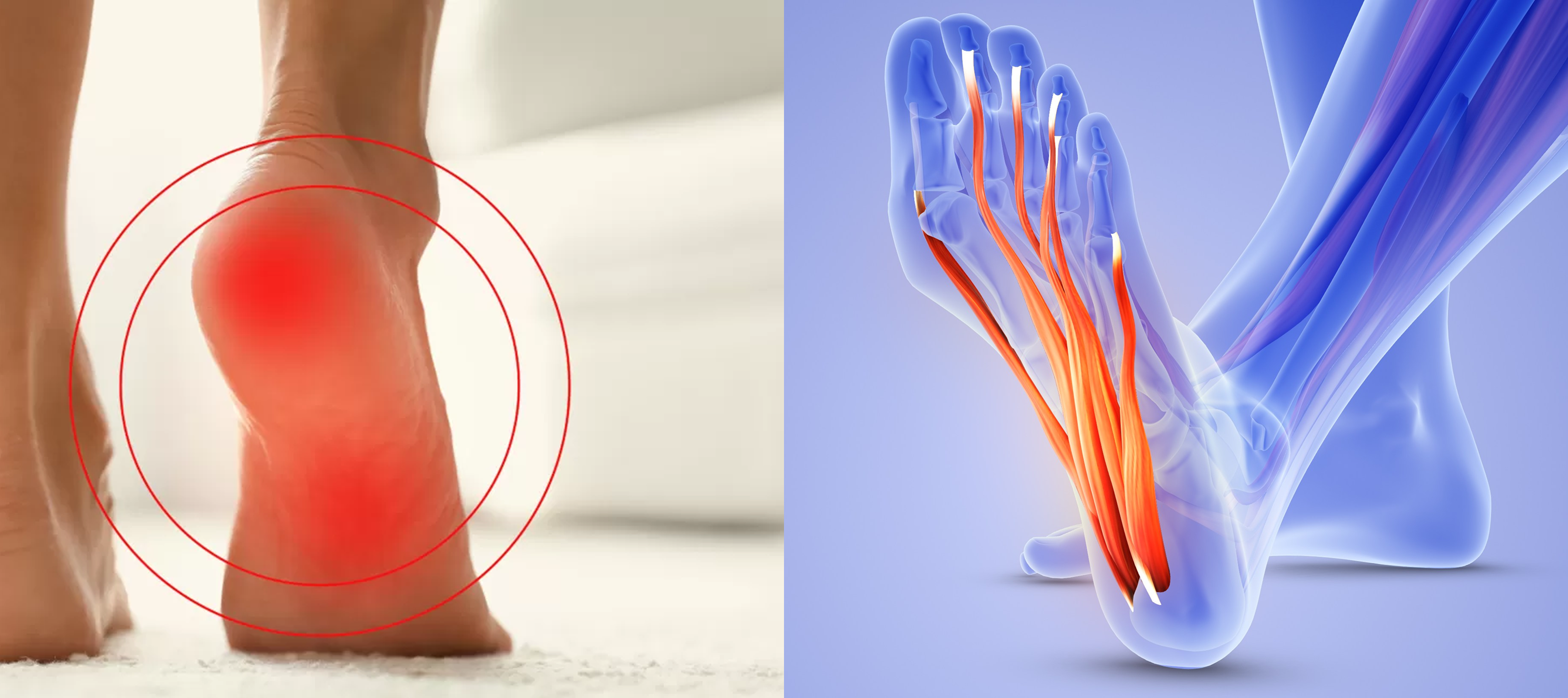 A split image showing a painful heel on the left and an anatomical diagram of foot muscles on the right.