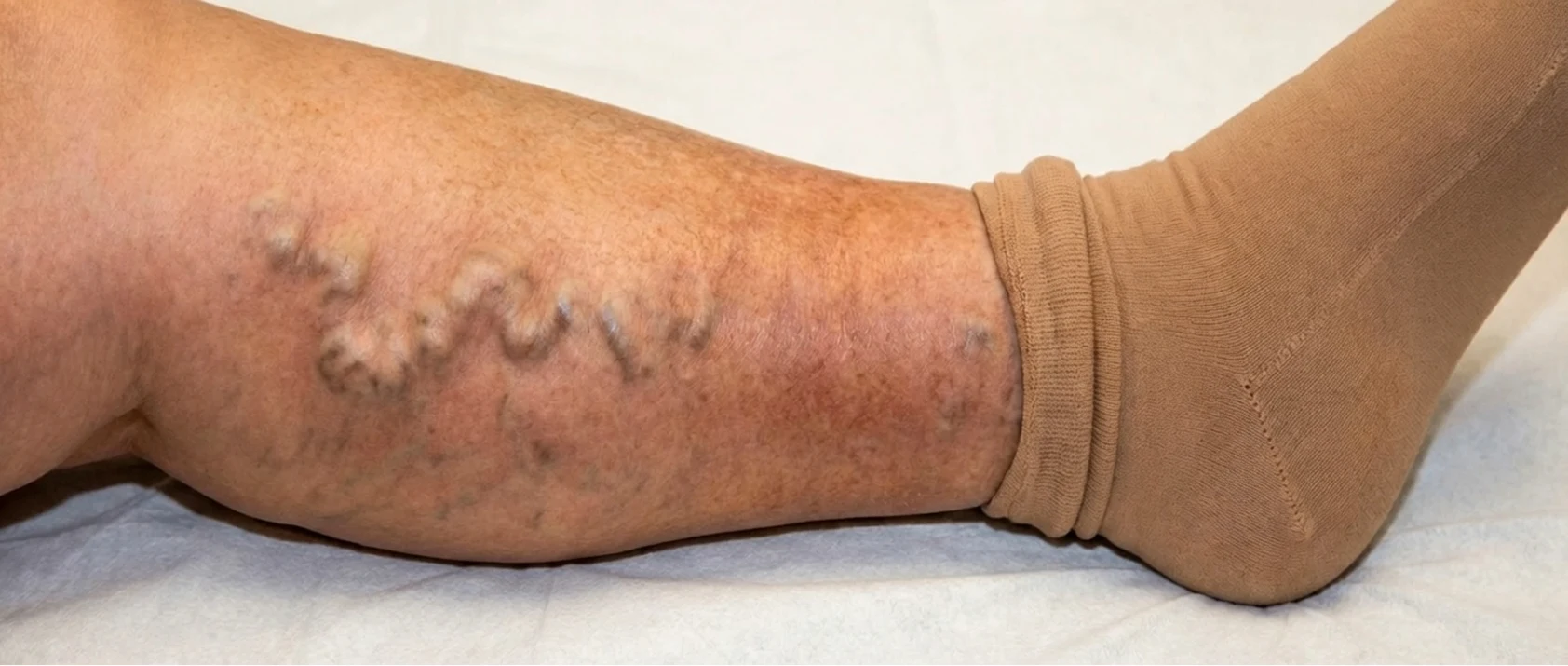A close-up of a lower leg with prominent varicose veins, with a beige compression sock on the foot.