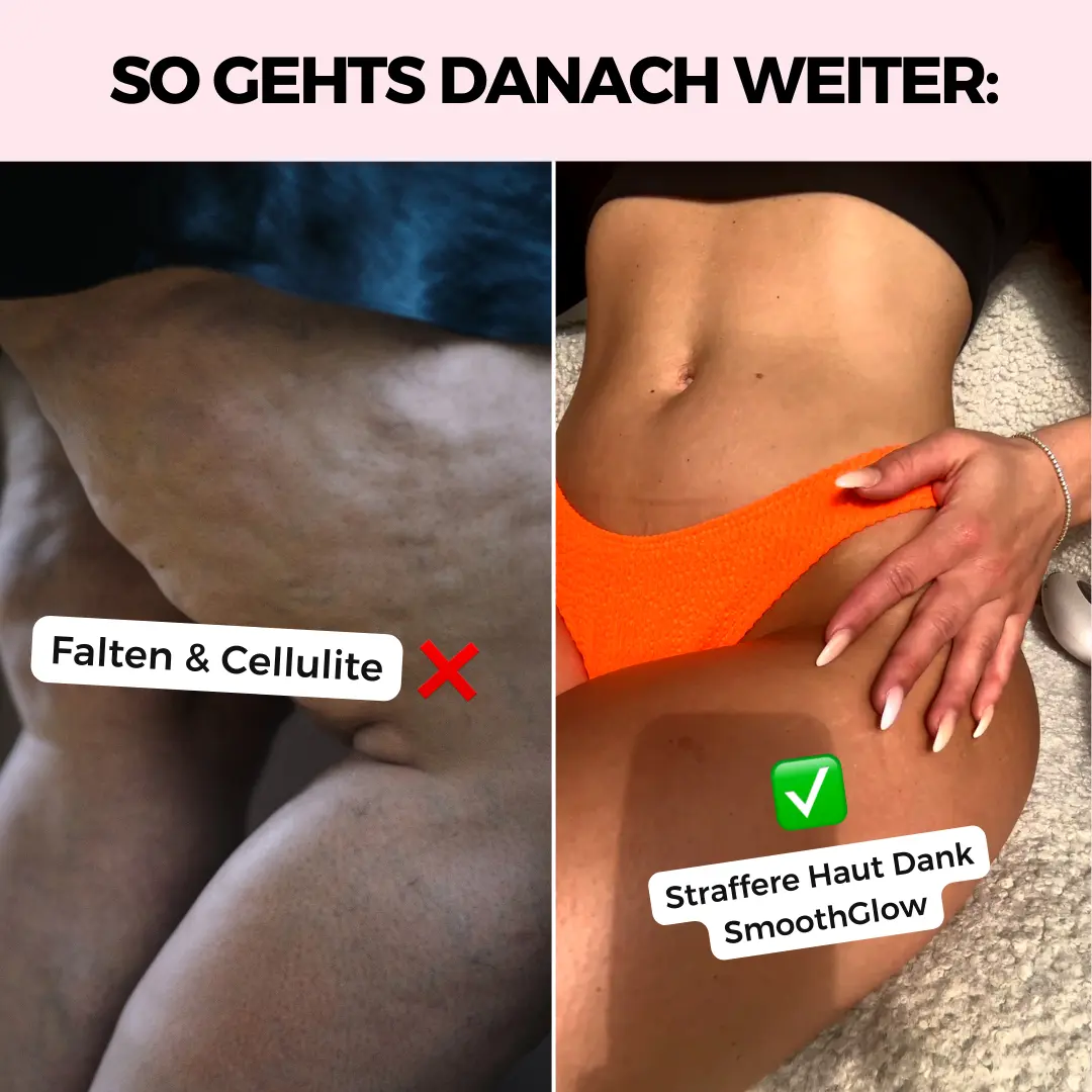 Comparison of skin with cellulite and smooth skin with text labels.