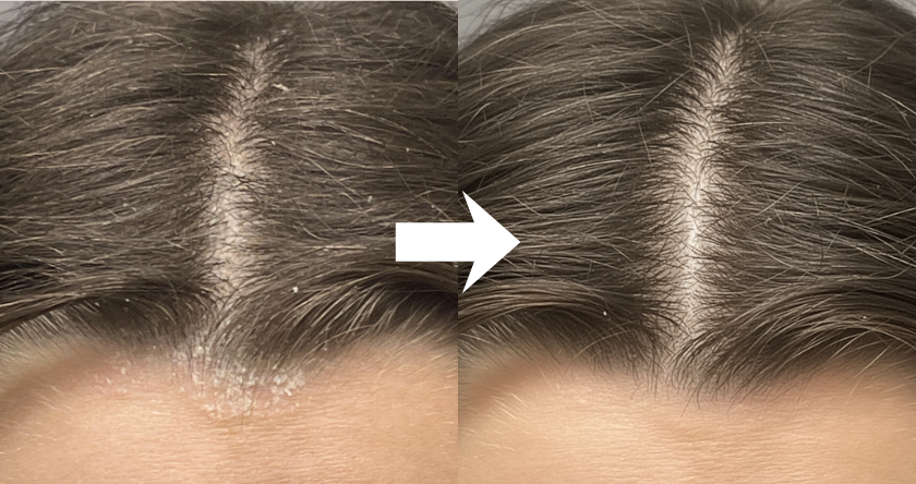 Before and after hair scalp close-up with an arrow in between.