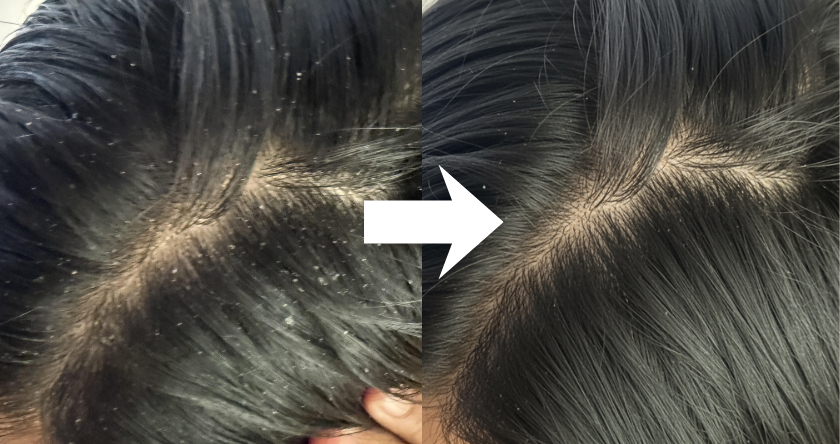 Before and after image of a scalp with reduced dandruff.