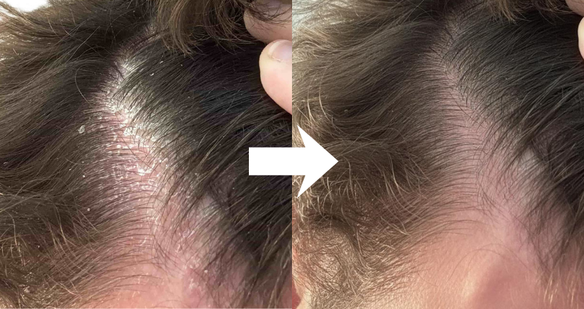 Side-by-side comparison of a flaky scalp before and after treatment.
