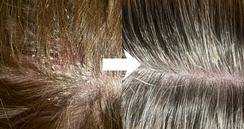 Comparison of scalps with dandruff before and after treatment.