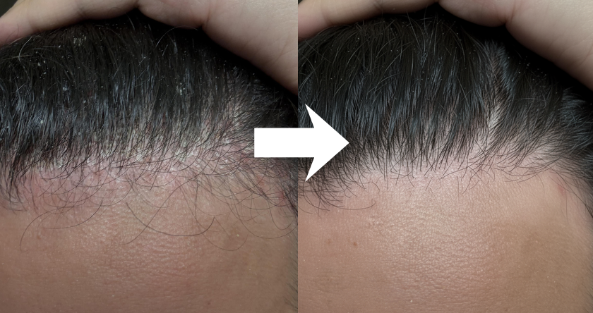 Side-by-side comparison of scalp before and after with an arrow pointing to improvement.