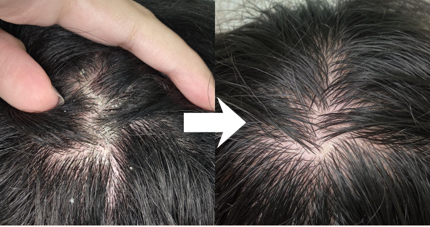 Comparison of scalp before and after treatment with white arrow between.