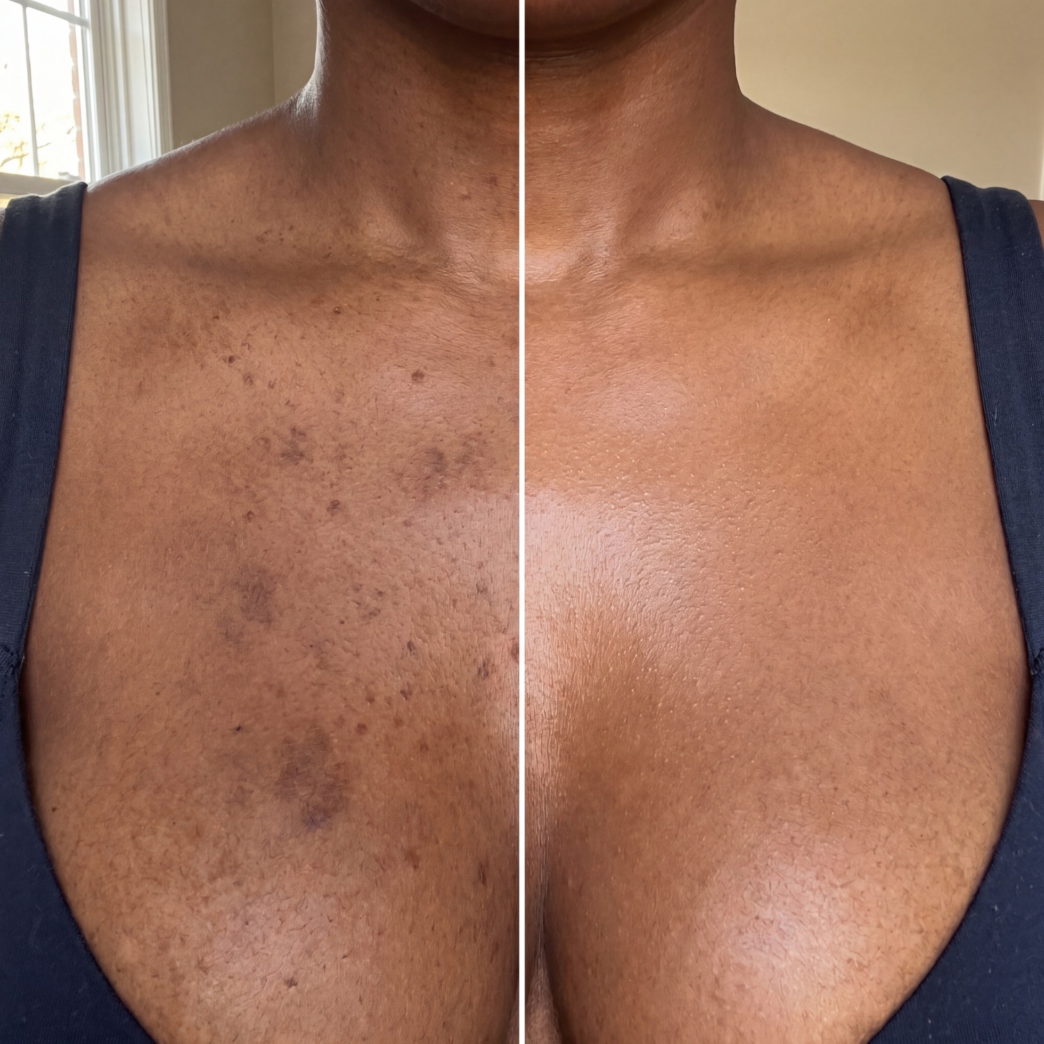 A before and after image showing the reduction of hyperpigmentation on a person's chest and neck area.
