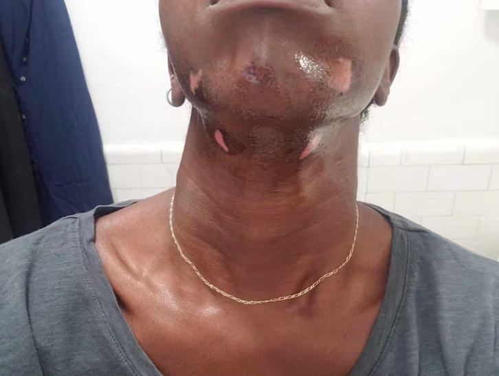 A close-up of a person's chin and neck with several patches of lighter, discolored skin.