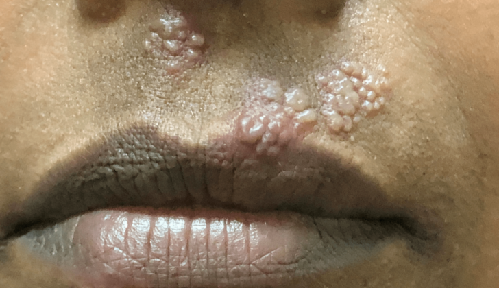 A close-up view of clusters of blisters on the skin above a person's upper lip.