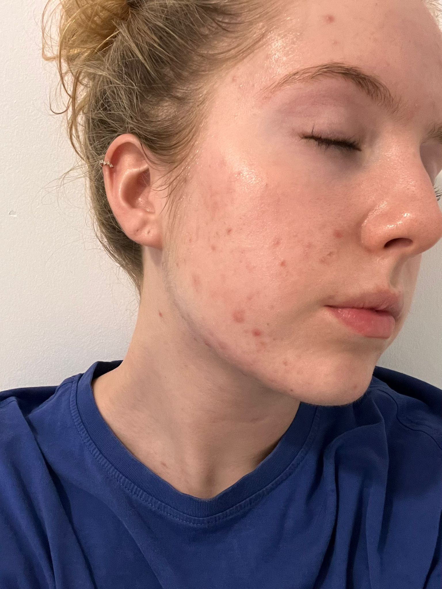 A close-up of a person's face in profile, with their eyes closed, showing acne on their cheek.