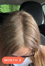A top-down view of a person's scalp and light brown hair, with an orange label that says 'MONTH 3'.