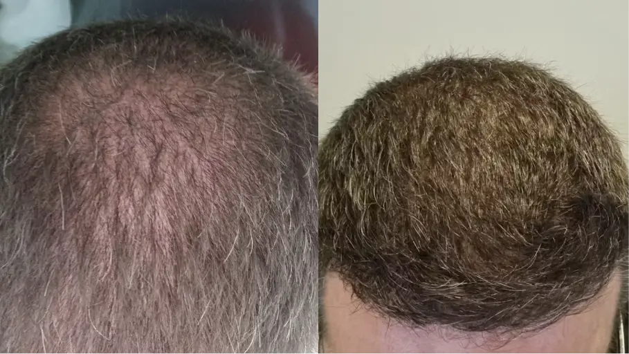 Side-by-side comparison of a balding and a fuller head of hair.