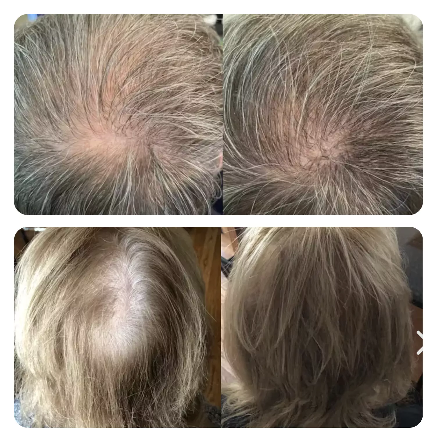 Before and after photos showing increased hair thickness and coverage on the crown of a head.