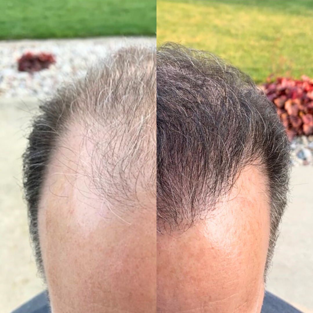 Before and after image showing hair growth on a person's head.