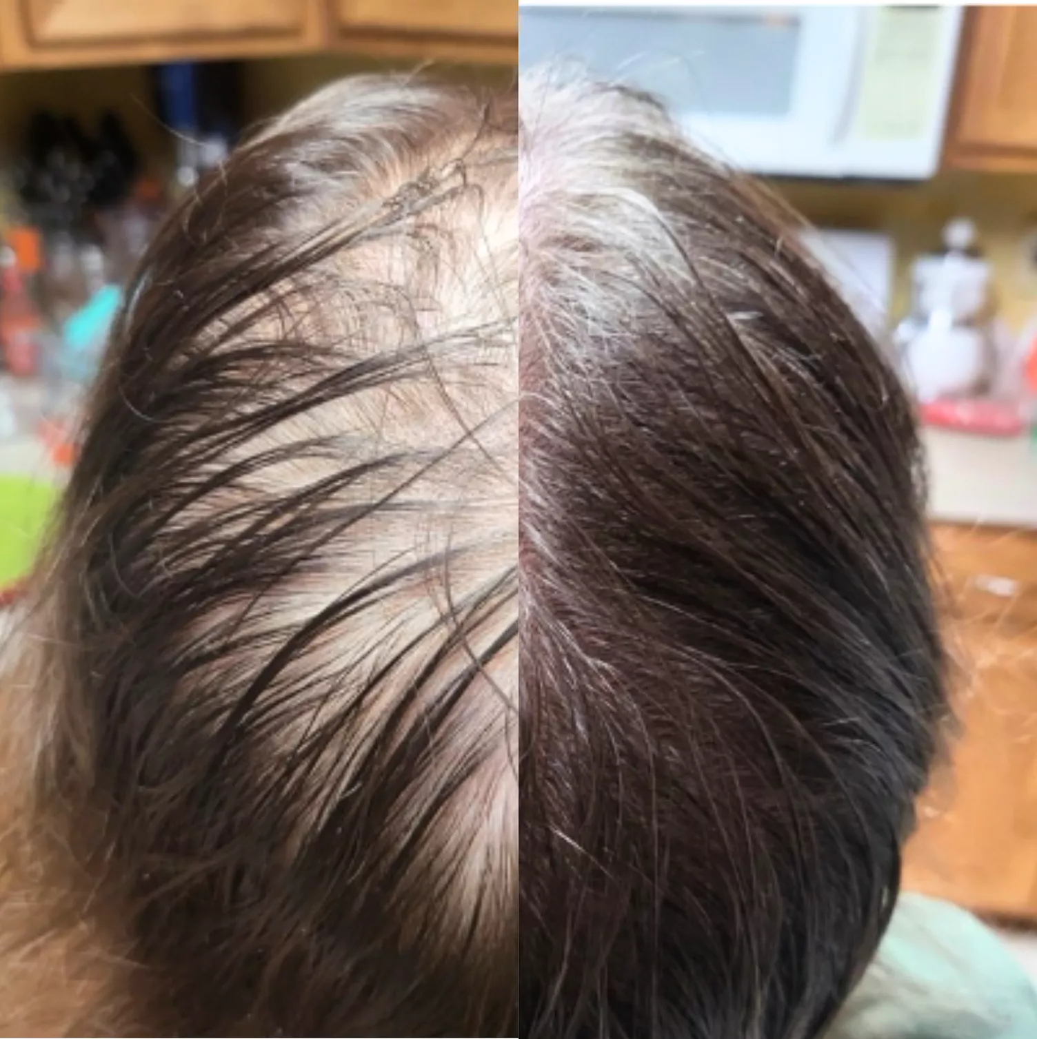 A split image showing a close-up of a scalp with thinning hair on the left and thicker hair on the right.