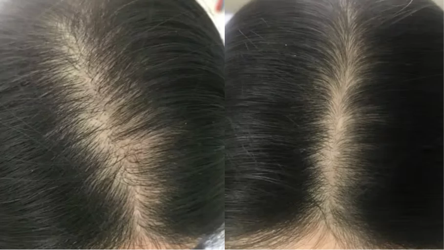 Side-by-side comparison of hair parting with visible scalp.