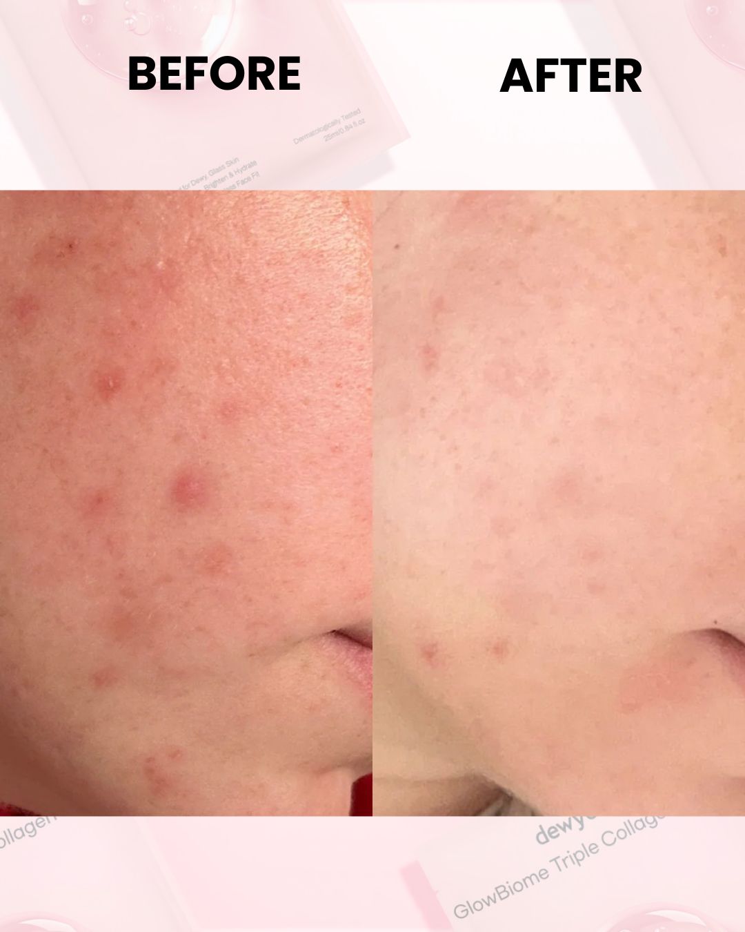 Side-by-side comparison of facial skin with acne before and after treatment.