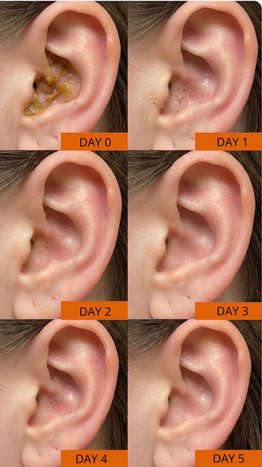 A collage of six photos showing an ear infection clearing up over a six-day period.