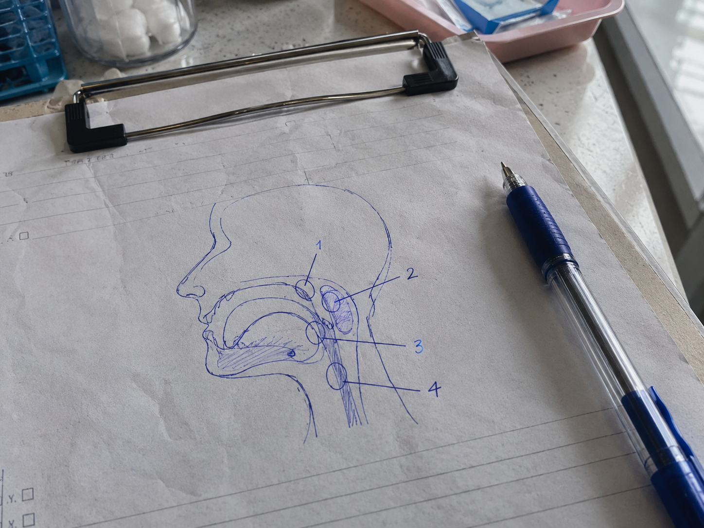 A dentist's pen sketch of a head in profile with the tonsils and back of the tongue circled and numbered