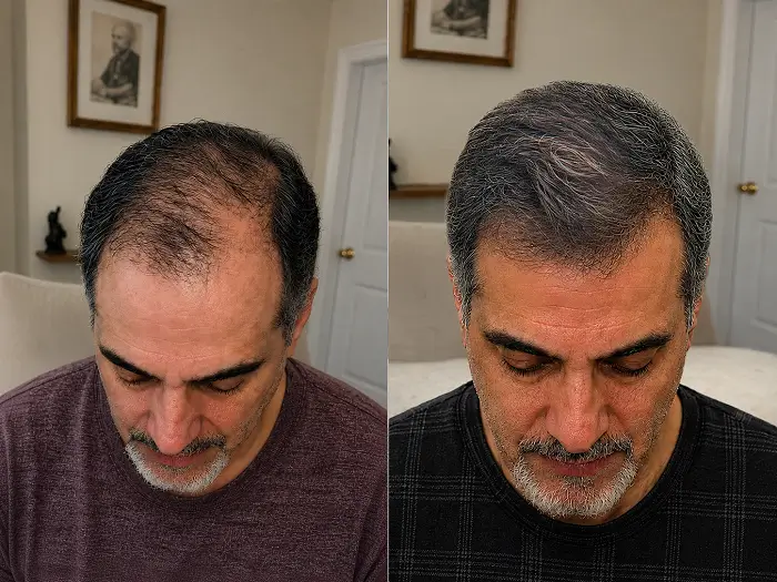 Side-by-side crown images with fuller-looking hair in the second photo.