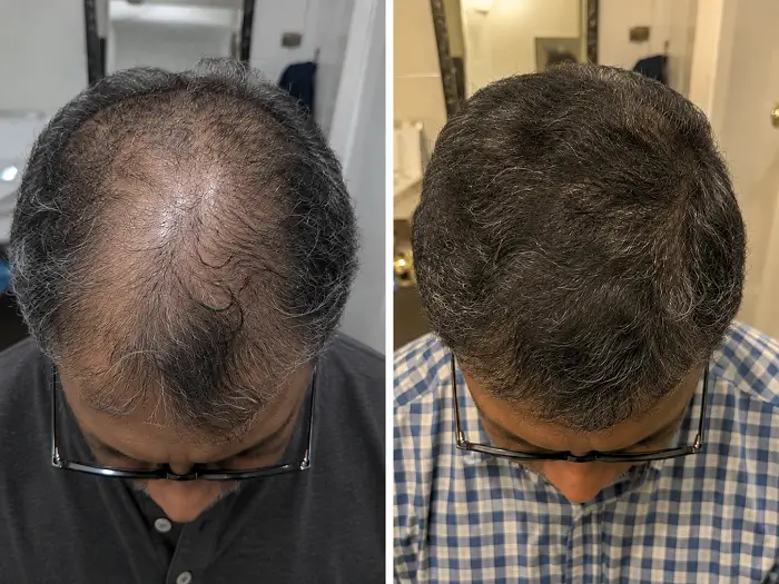Before-and-after comparison showing fuller-looking hair at the crown.