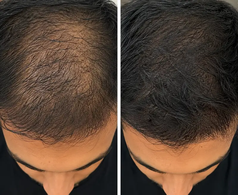 Before-and-after comparison showing improved hair coverage across the top.
