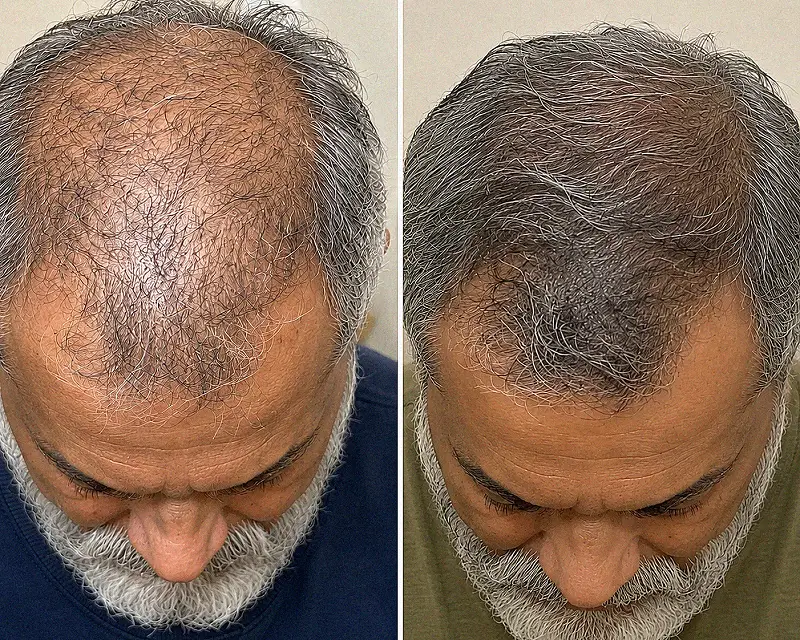 Two crown views showing denser-looking gray hair in the second photo.