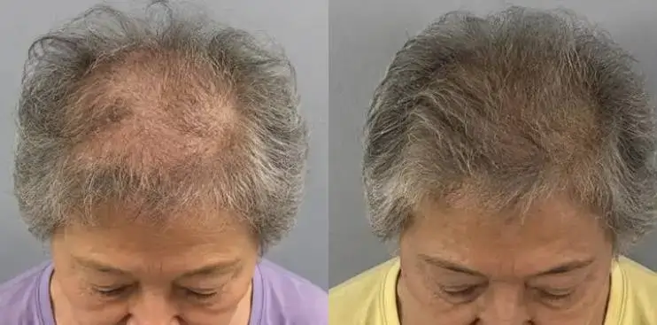 Before-and-after comparison showing fuller-looking gray hair at the crown.