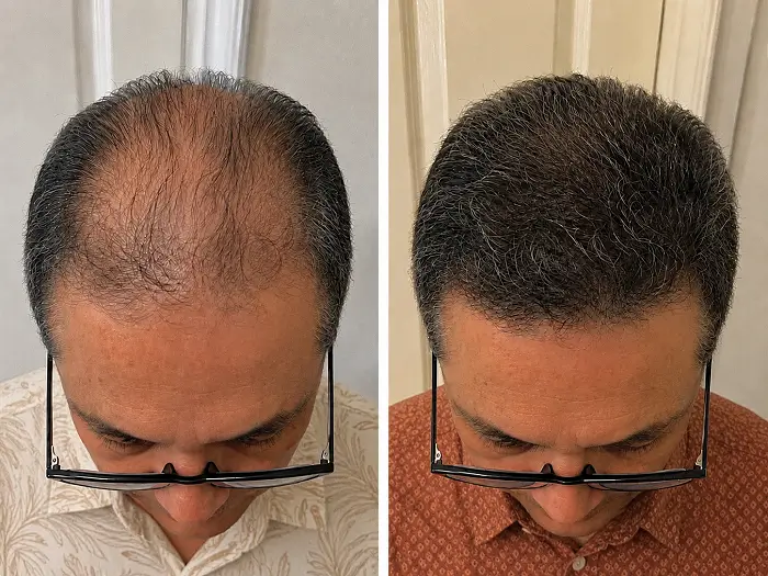 Two photos showing fuller-looking hair at the front and crown.