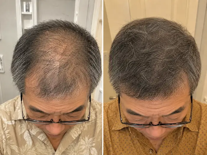 Crown area appearing fuller in the second image.