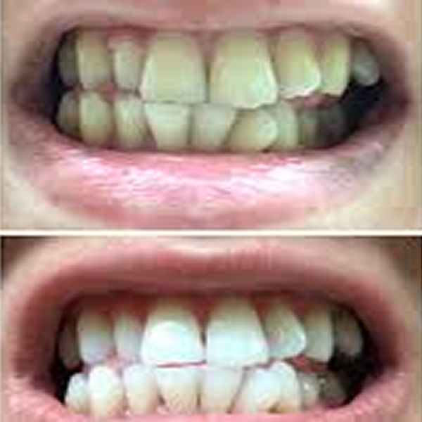 Two images showing teeth before and after whitening.