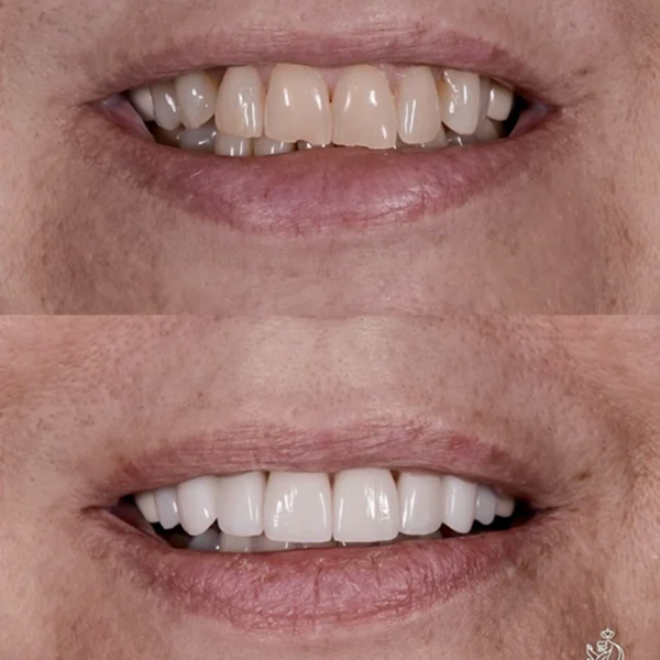 Before and after dental transformation showing improved teeth appearance.