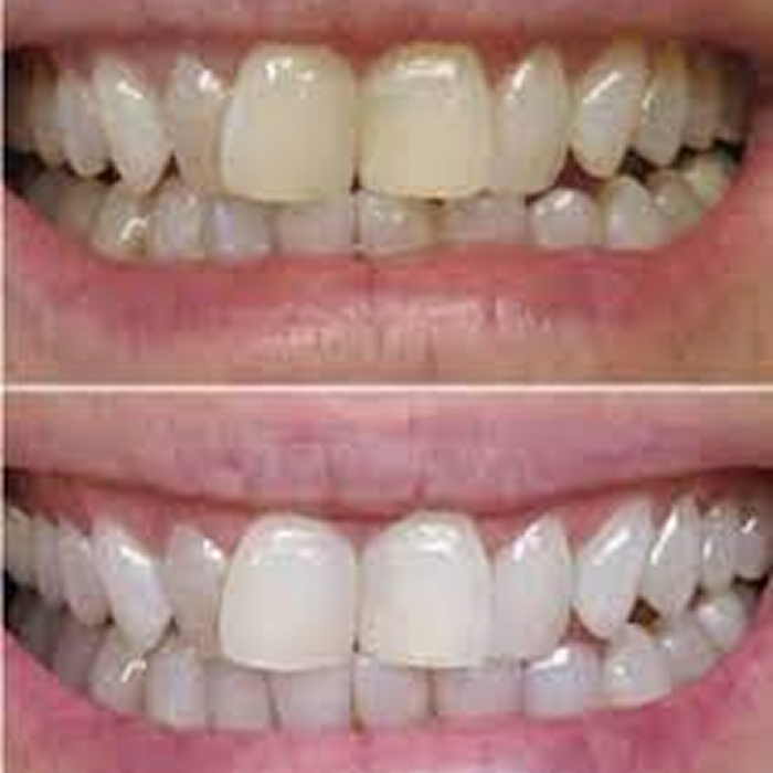 Two images showing teeth before and after whitening.