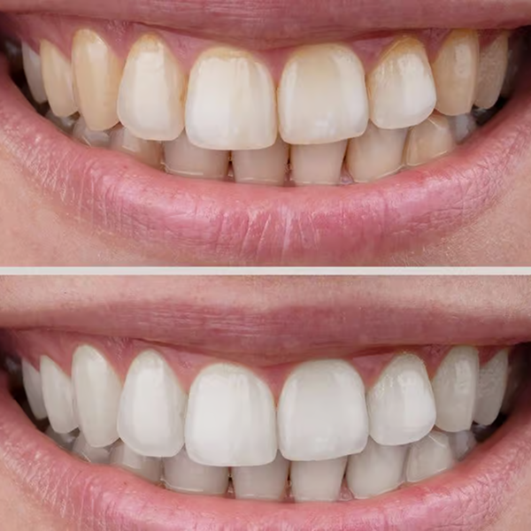 Before and after image showing teeth whitening results.