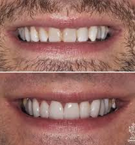 Two close-up images showing teeth before and after dental treatment.