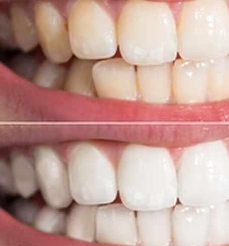 Close-up of two rows of white teeth with pink gums.